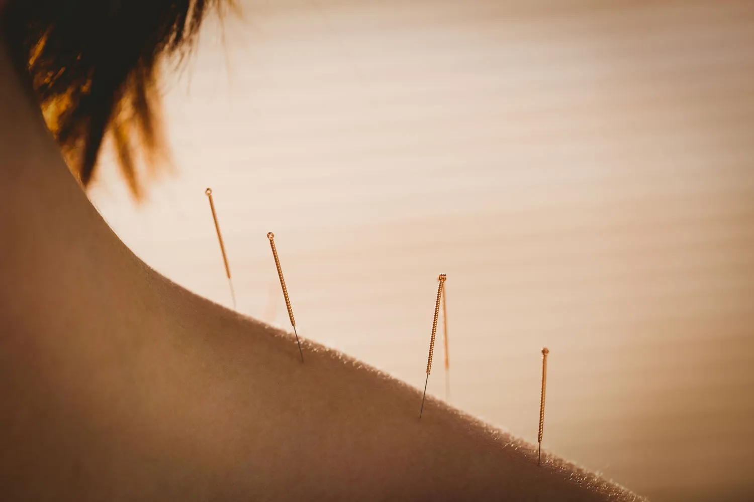 acupuncture in rotherham & doncaster